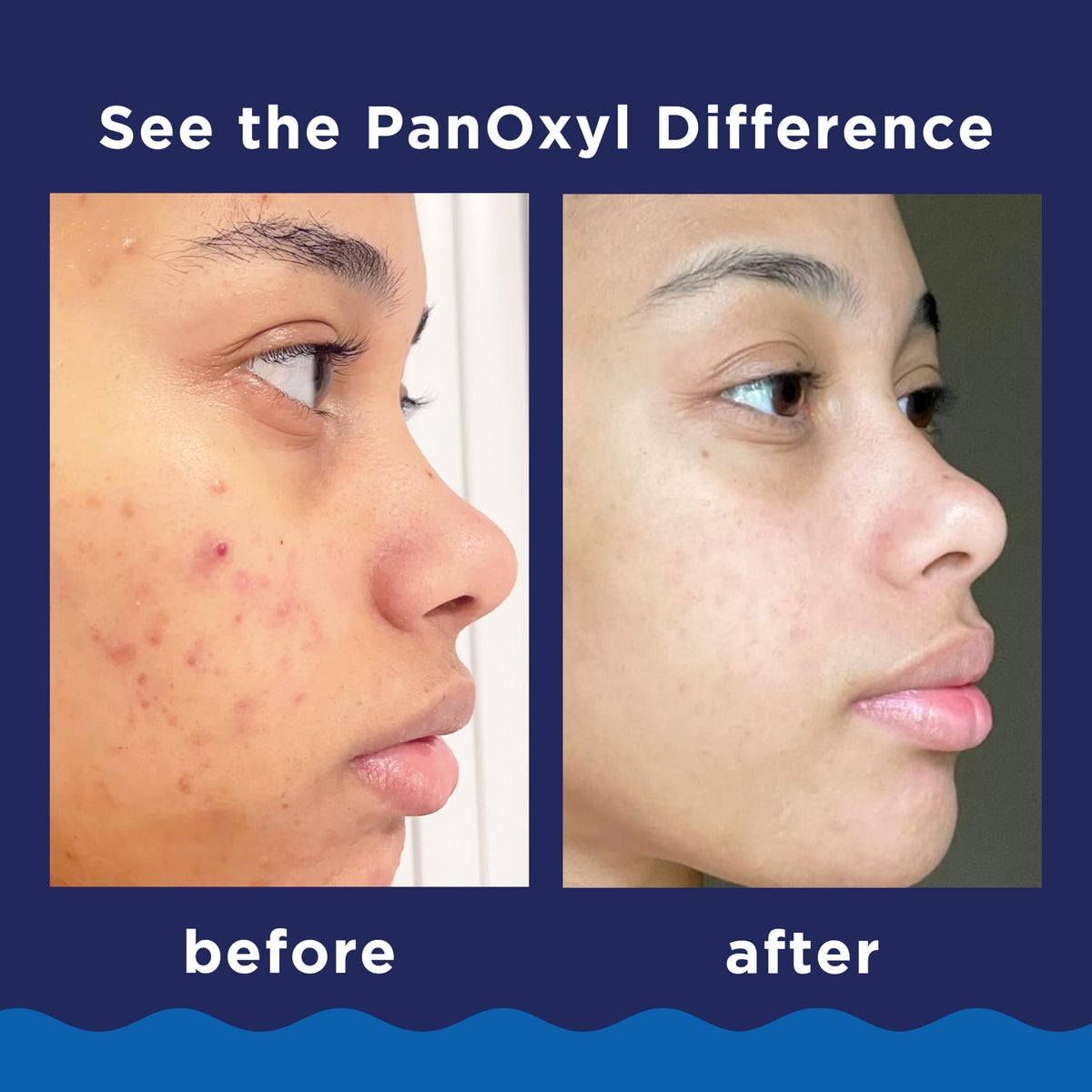PanOxyl Acne Foaming Wash 10 Benzoyl Peroxide For Face Body – full view