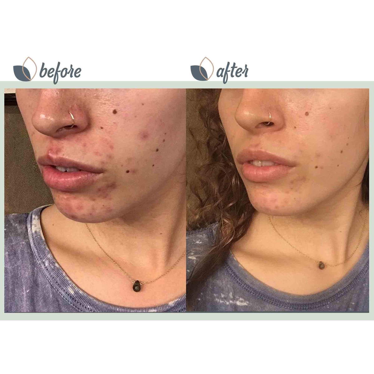 BioClarity 3 Step Acne Routine Mini Size for Oily or Acne - BioClarity Official Imagery - 5