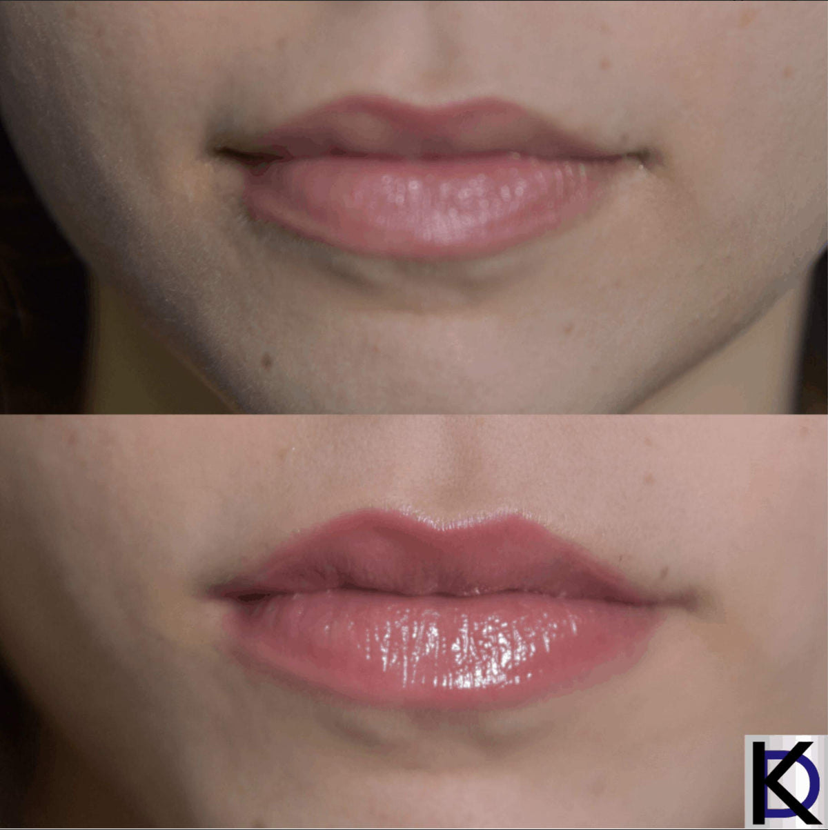KD High Volume Lip Plumping Amplifier - KD Skincare Official Imagery - 3