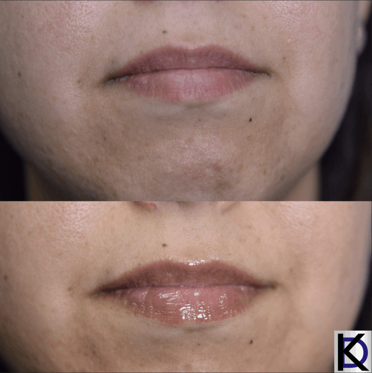 KD High Volume Lip Plumping Amplifier - KD Skincare Official Imagery - 5