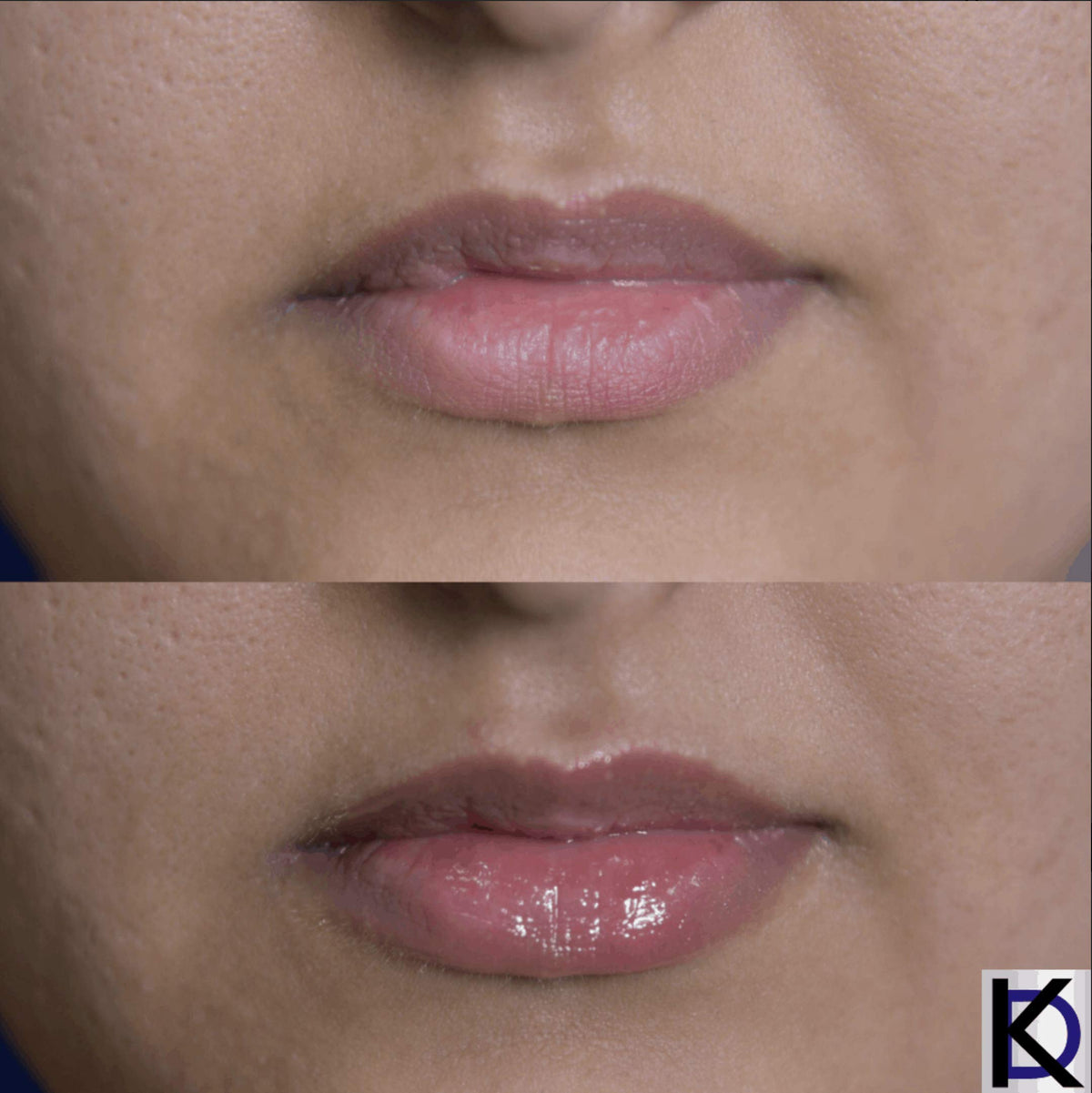 KD High Volume Lip Plumping Amplifier - KD Skincare Official Imagery - 4
