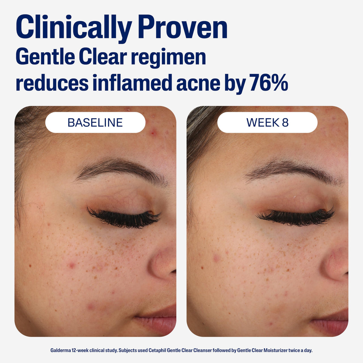 Cetaphil Gentle Clear Mattifying Acne Face Moisturizer – alternate angle